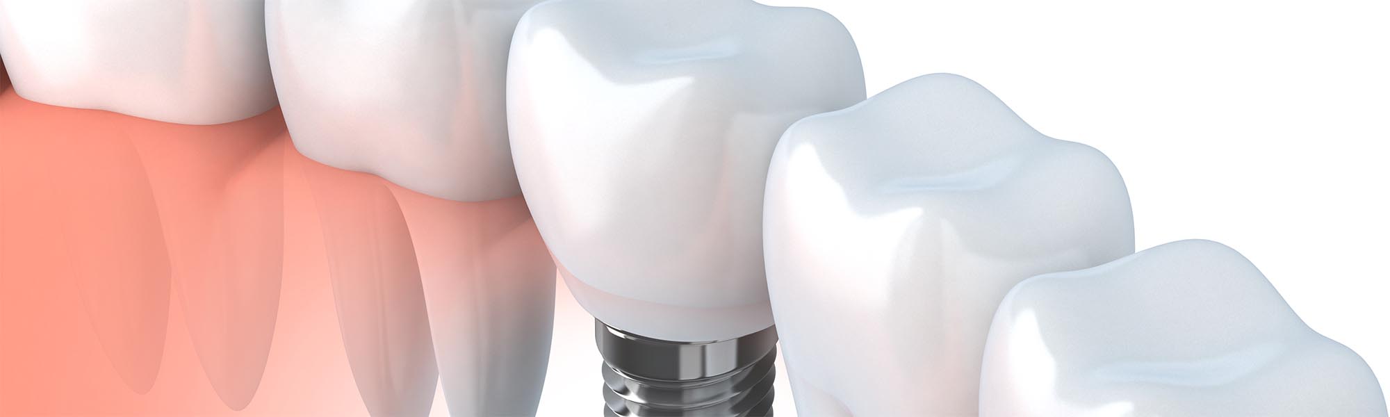 Single Tooth Implants El Segundo CA