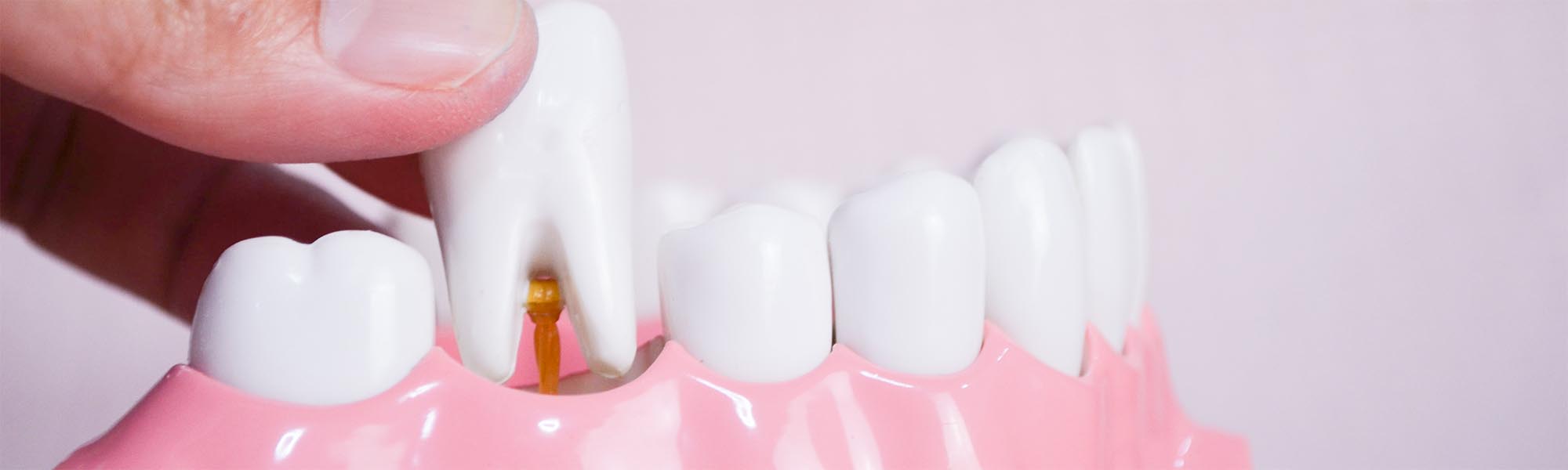 Wisdom Teeth Removal Cost El Segundo CA