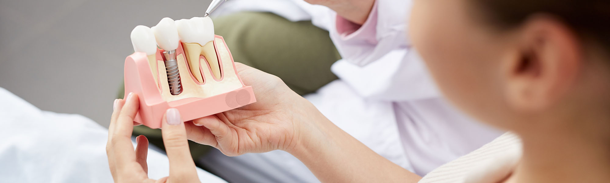 Dental Implants Process and Recovery