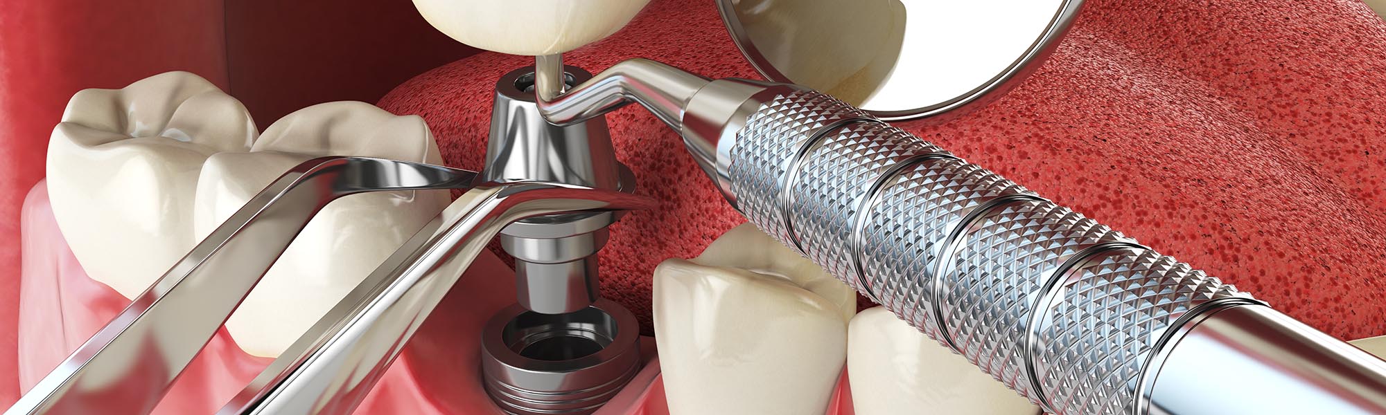 Dental Implants Dentists El Segundo CA