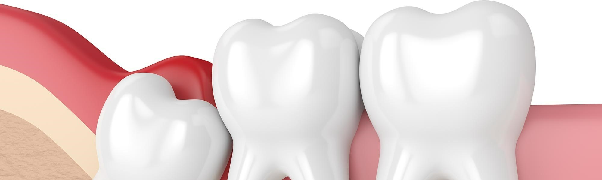 Tooth Extractions El Segundo CA