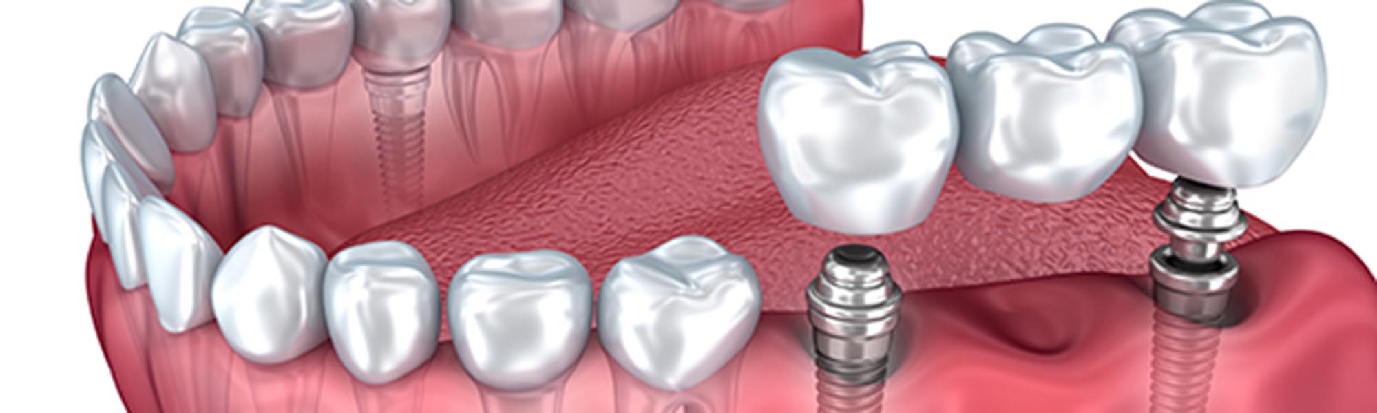 Multiple Teeth Implants Dentistry El Segundo CA