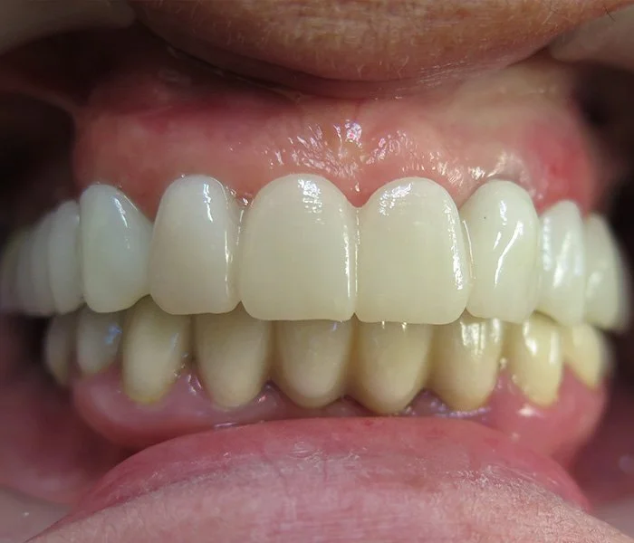 Dental Implants El Segundo After