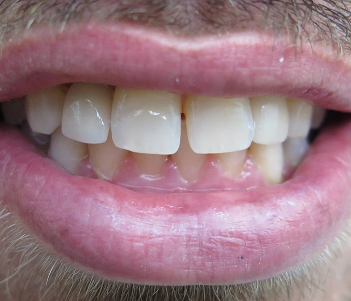 Dental Implants El Segundo After