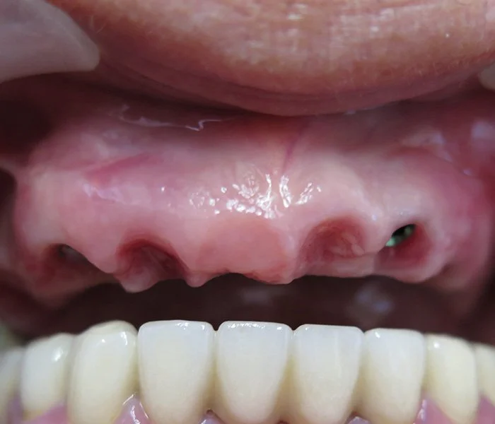 Dental Implants El Segundo Before