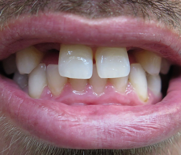 Dental Implants El Segundo Before
